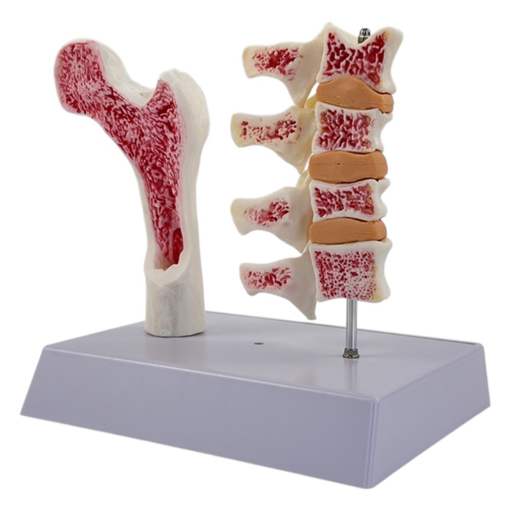 Human Spine Osteoporosis Model for Medical Teaching Education